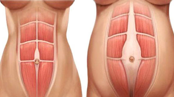 diastasis